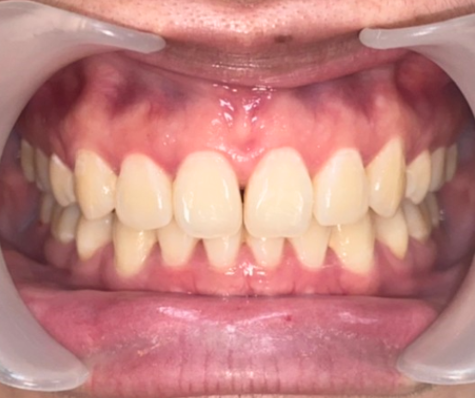 gaped teeth space teeth ฟันห่าง ฟันหน้าห่าง