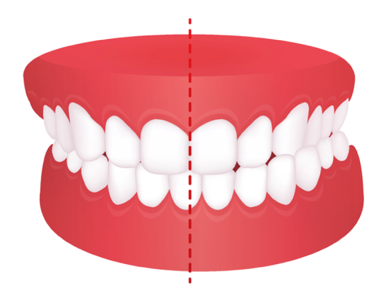 ฟันกัดเบี้ยว เส้นกลางฟันไม่ตรง midline teeth