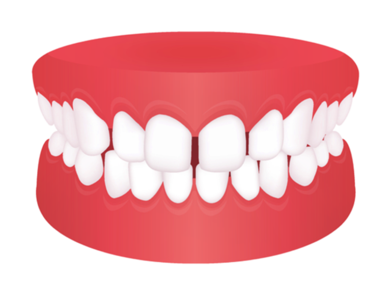 Gap teeth space teeth ฟันห่าง