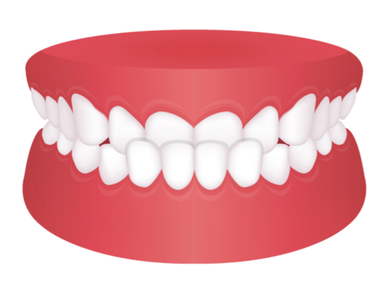 ฟันล่างยื่น ฟันล่างคร่อมฟันบน Crossbite