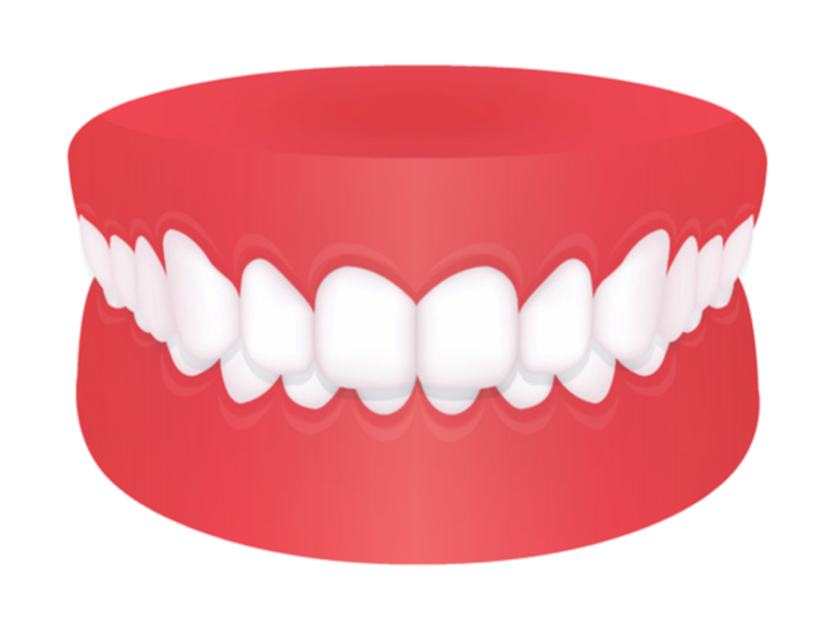 ฟันสบลึก ฟันบนคร่อมฟันล่าง Deep Bite