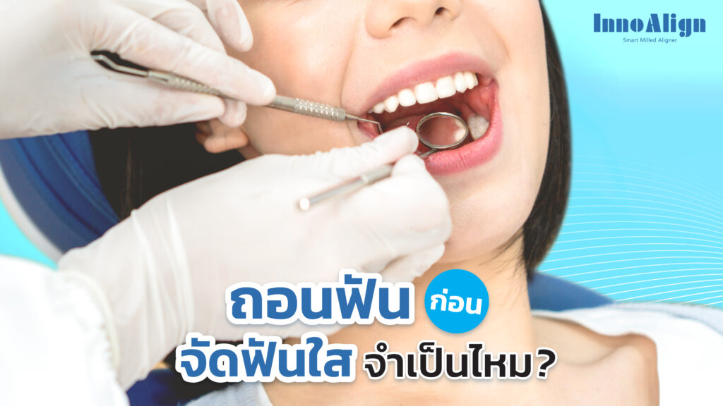 ถอนฟันก่อนจัดฟันใส